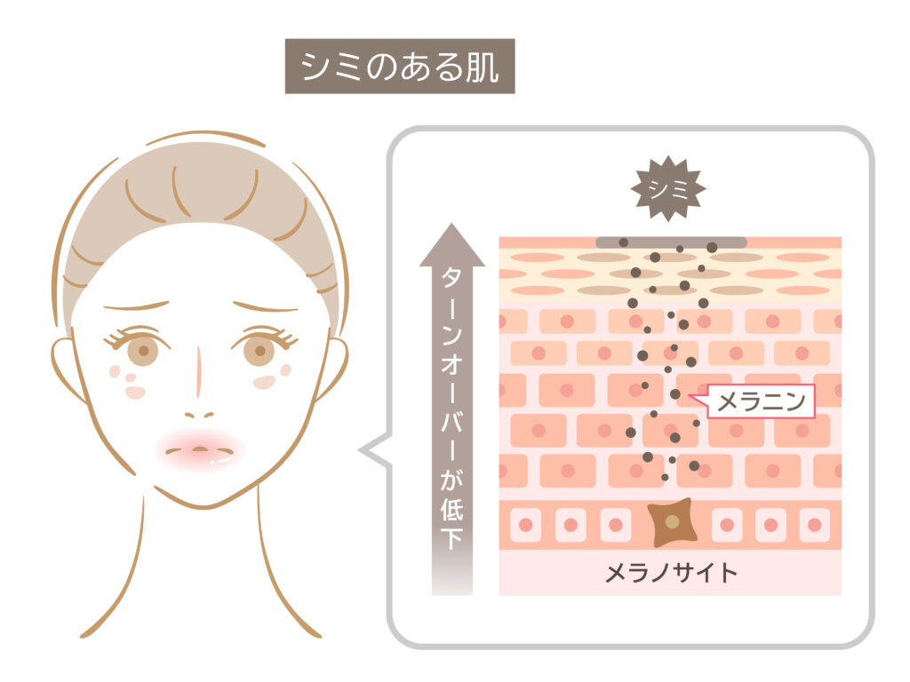 シミのある肌のターンオーバー
