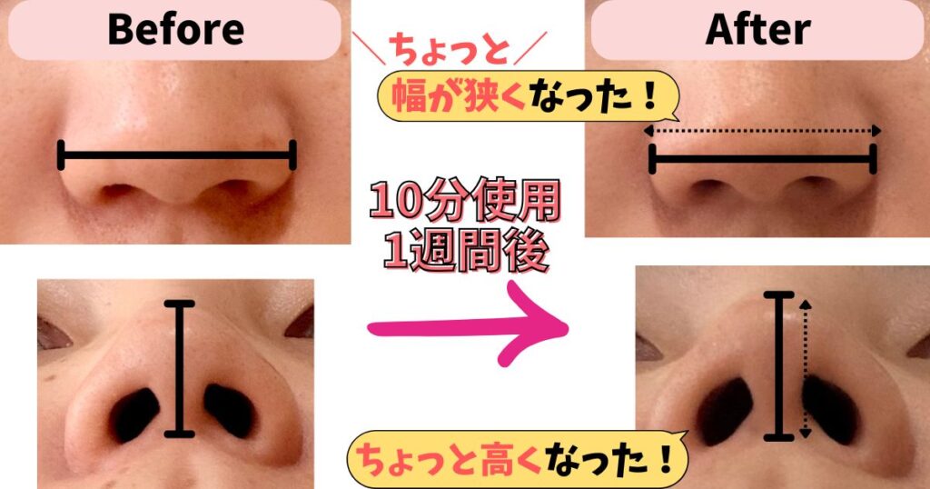 使用1週間後:直後でなくてもちょっと鼻がシュッとしてきた